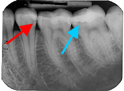 Zahnröntgen mit Karies