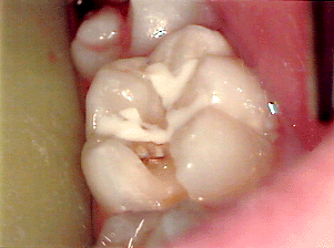 Schmerzender Zahn trotz Zahnversiegelung